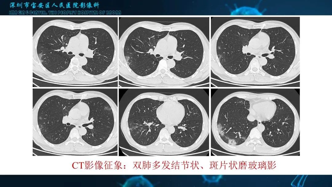 【PPT】输入性新型冠状病毒肺炎早期CT表现