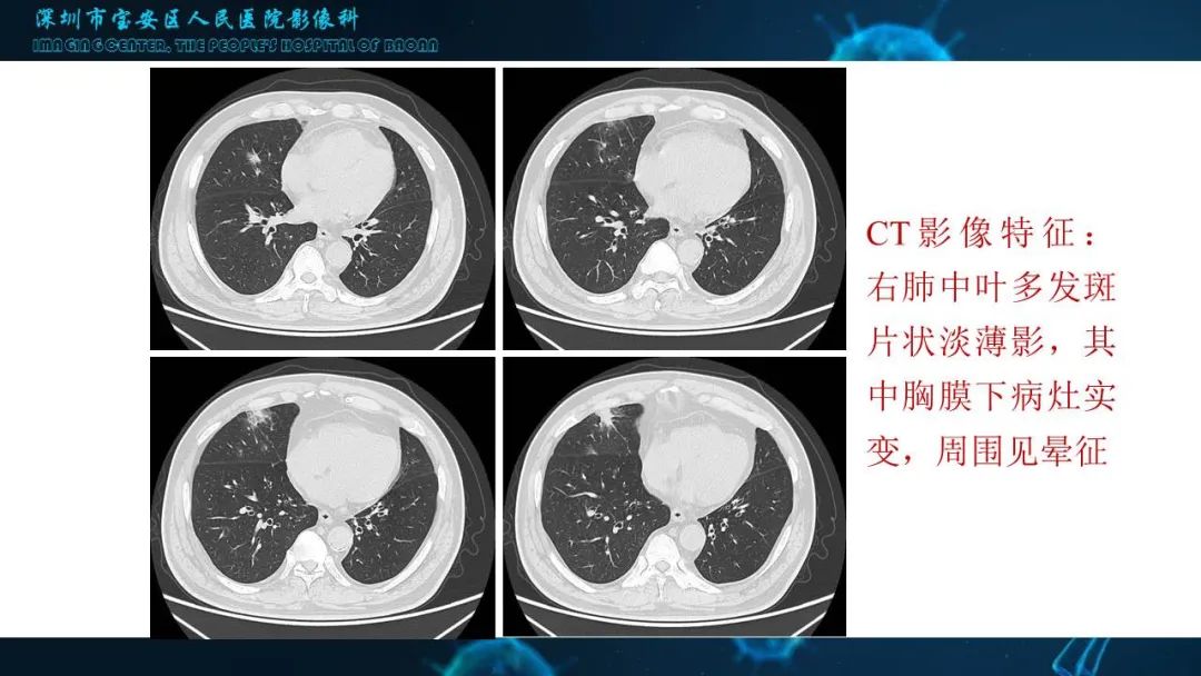 【PPT】输入性新型冠状病毒肺炎早期CT表现