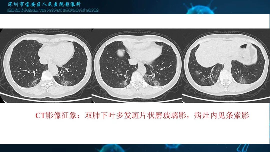 【PPT】输入性新型冠状病毒肺炎早期CT表现