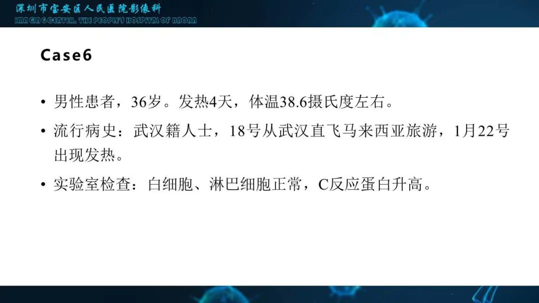 【PPT】输入性新型冠状病毒肺炎早期CT表现