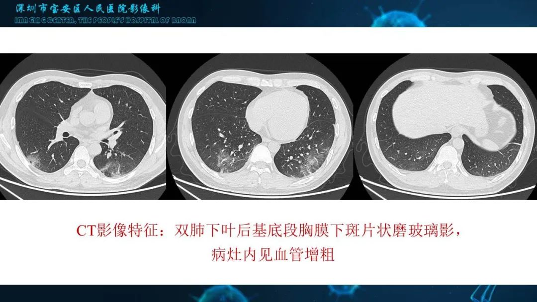 【PPT】输入性新型冠状病毒肺炎早期CT表现