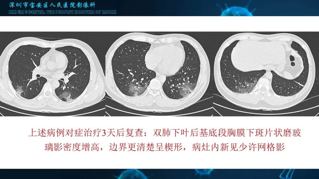 【PPT】输入性新型冠状病毒肺炎早期CT表现