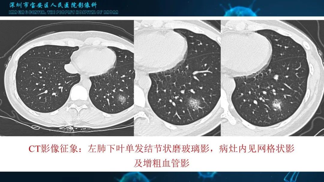 【PPT】输入性新型冠状病毒肺炎早期CT表现