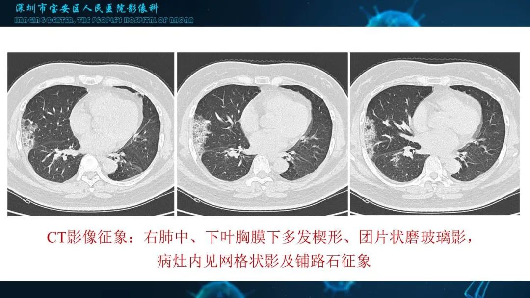【PPT】输入性新型冠状病毒肺炎早期CT表现