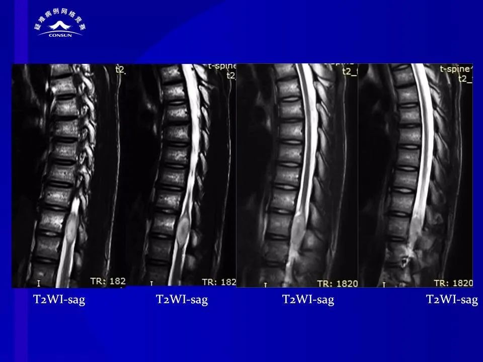 【病例】脊髓节细胞胶质瘤1例MR影像解析