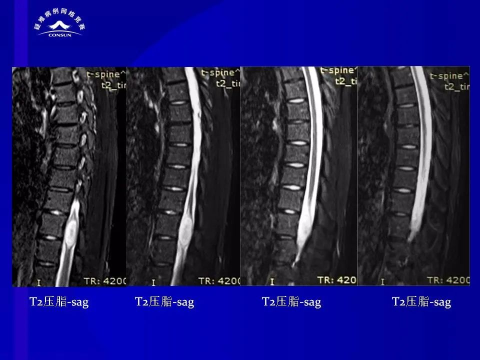 【病例】脊髓节细胞胶质瘤1例MR影像解析