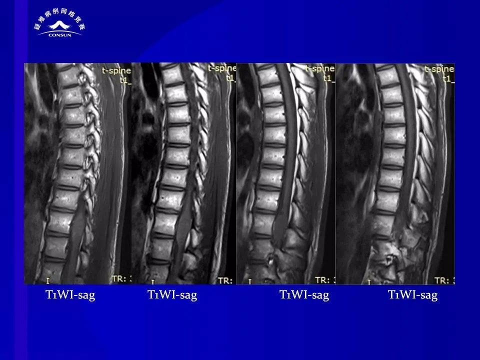 【病例】脊髓节细胞胶质瘤1例MR影像解析