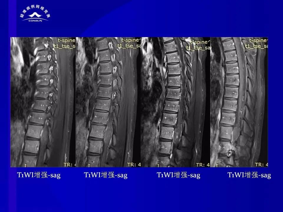 【病例】脊髓节细胞胶质瘤1例MR影像解析