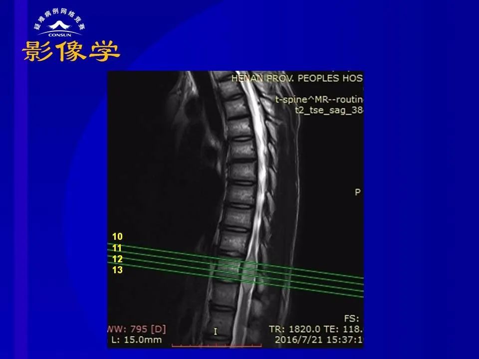 【病例】脊髓节细胞胶质瘤1例MR影像解析