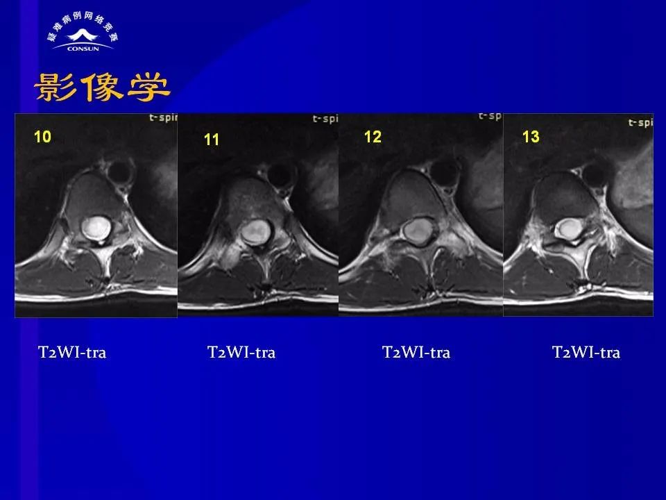 【病例】脊髓节细胞胶质瘤1例MR影像解析