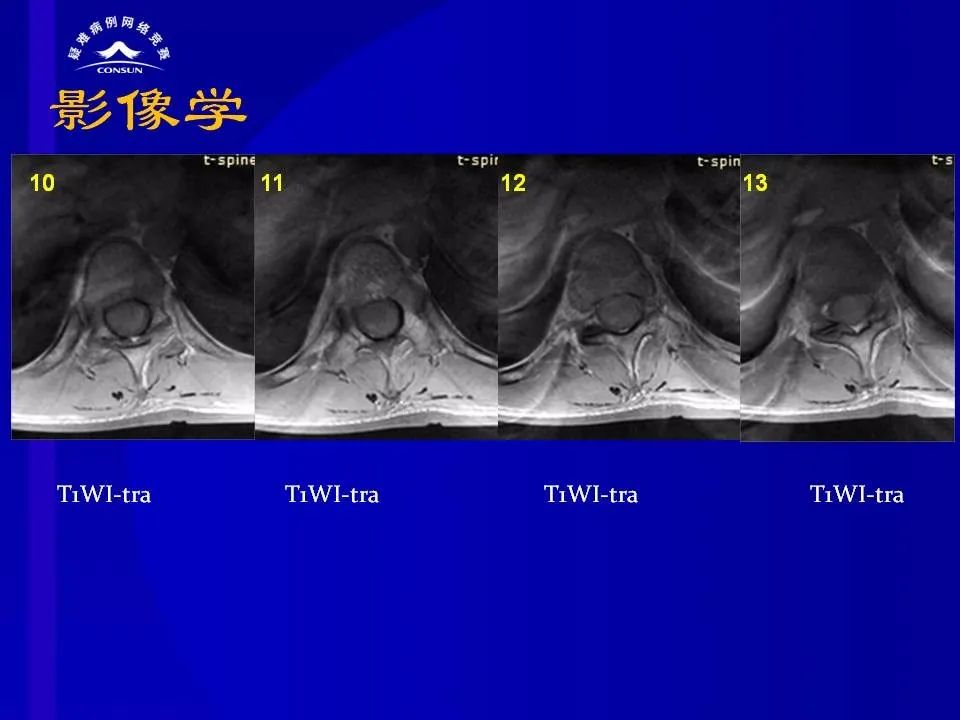 【病例】脊髓节细胞胶质瘤1例MR影像解析