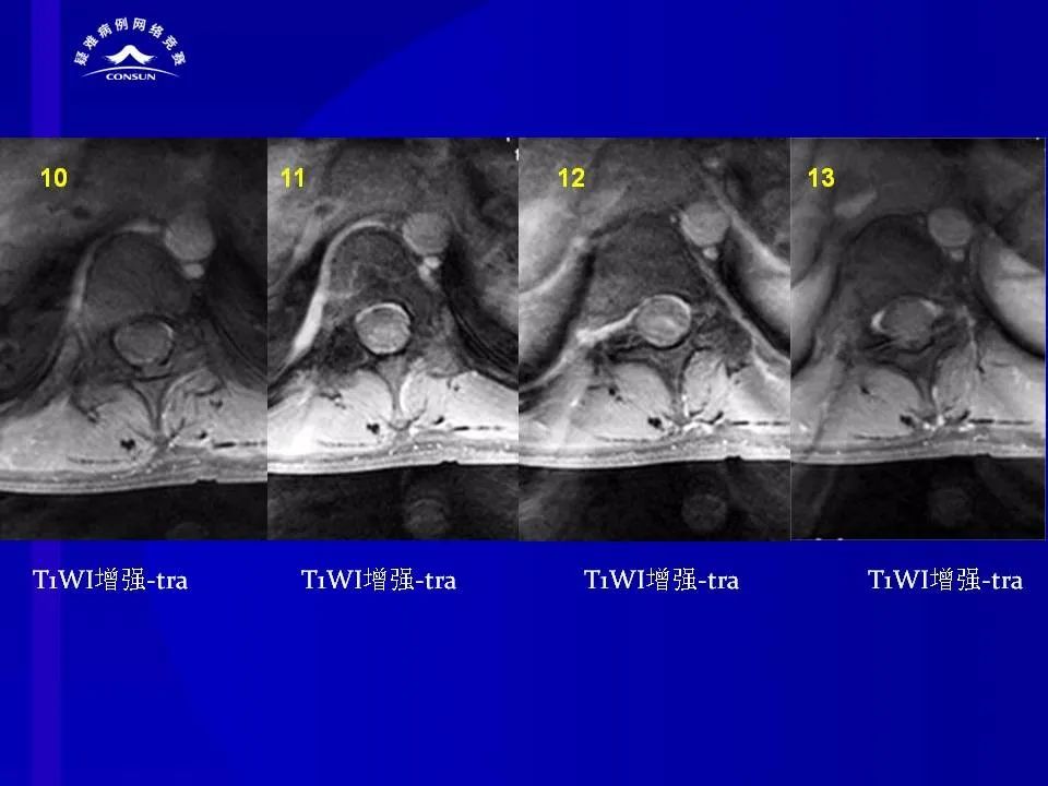 【病例】脊髓节细胞胶质瘤1例MR影像解析
