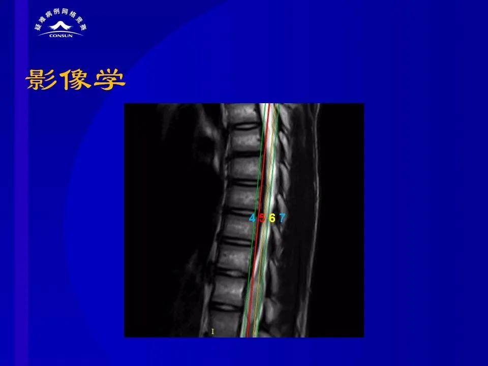 【病例】脊髓节细胞胶质瘤1例MR影像解析
