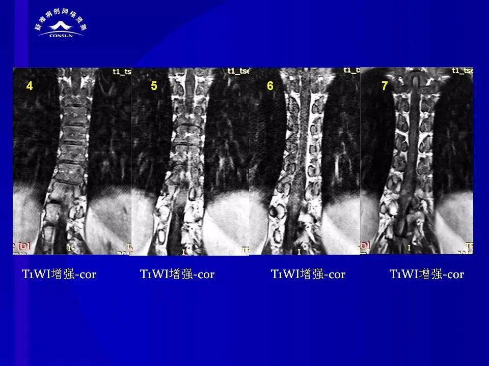 【病例】脊髓节细胞胶质瘤1例MR影像解析