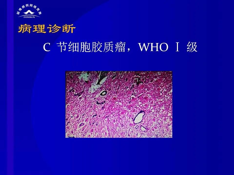 【病例】脊髓节细胞胶质瘤1例MR影像解析