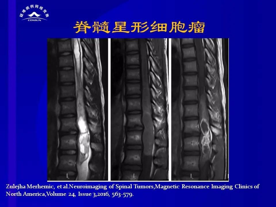 【病例】脊髓节细胞胶质瘤1例MR影像解析
