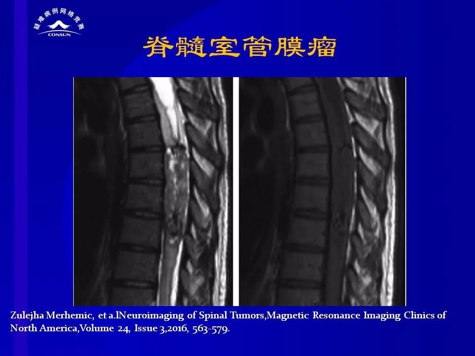 【病例】脊髓节细胞胶质瘤1例MR影像解析