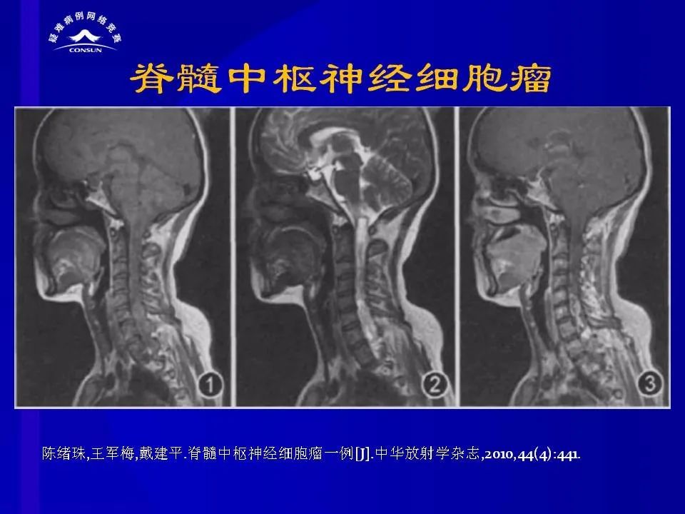 【病例】脊髓节细胞胶质瘤1例MR影像解析