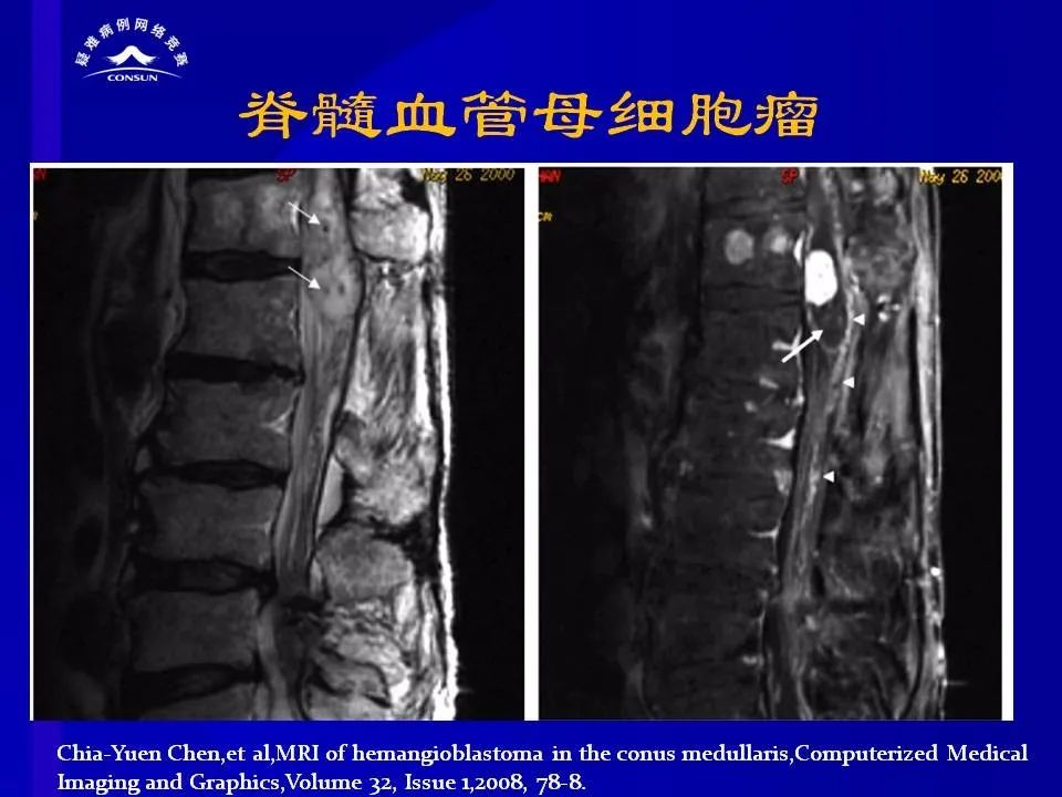 【病例】脊髓节细胞胶质瘤1例MR影像解析