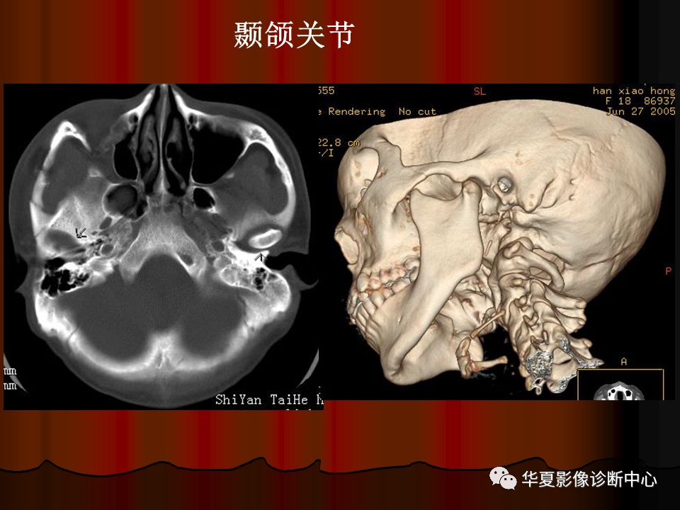 【PPT】口腔颌面部CT诊断