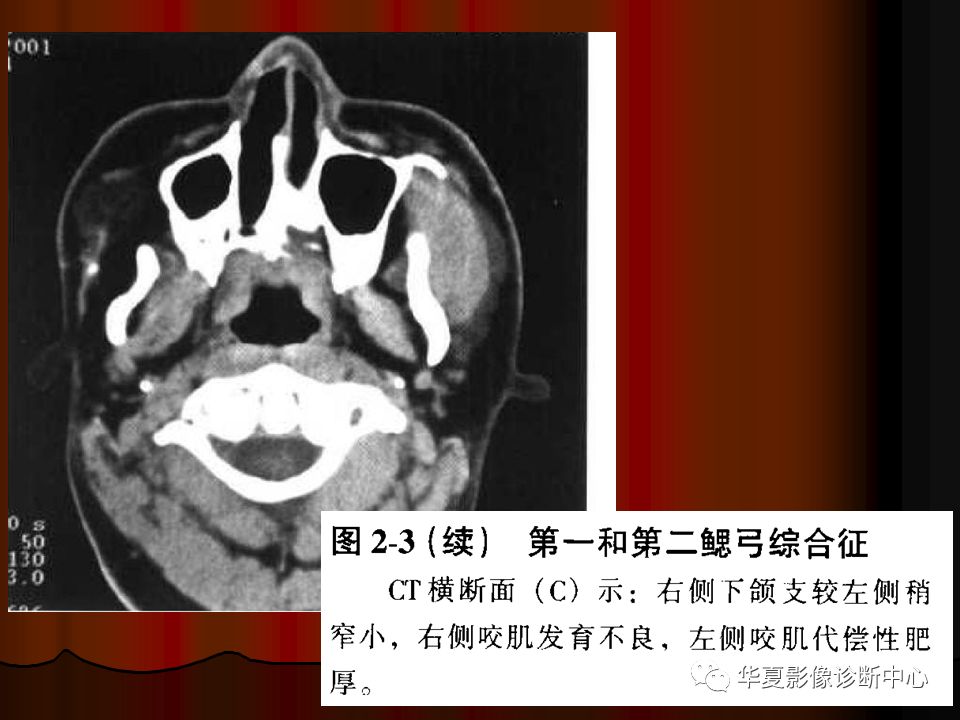【PPT】口腔颌面部CT诊断