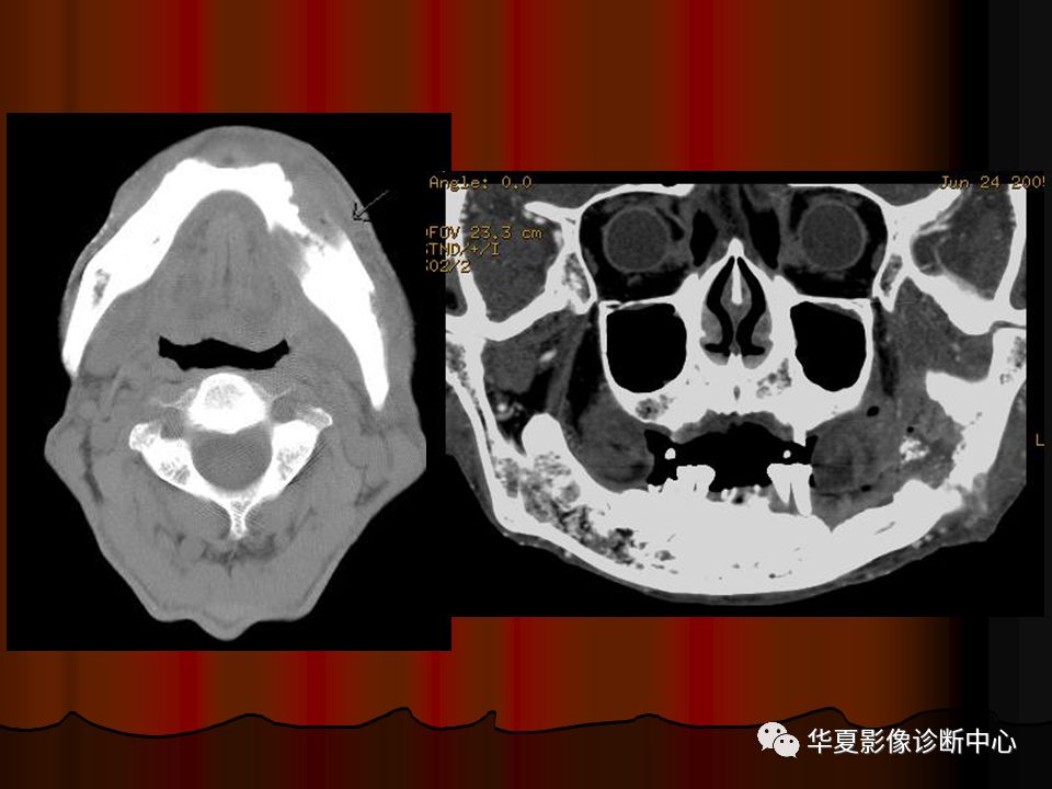 【PPT】口腔颌面部CT诊断