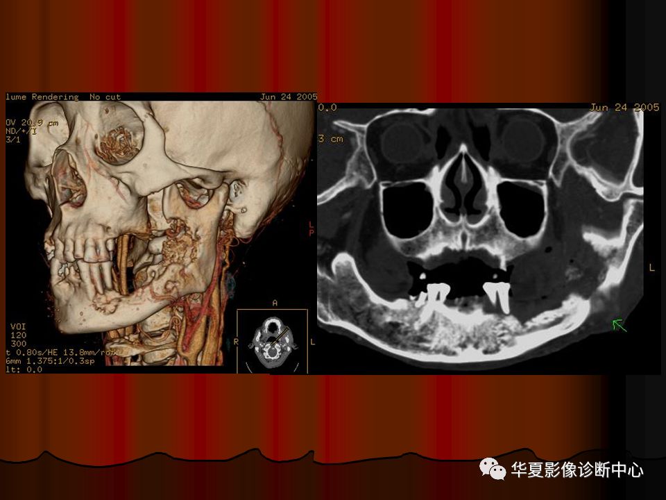 【PPT】口腔颌面部CT诊断