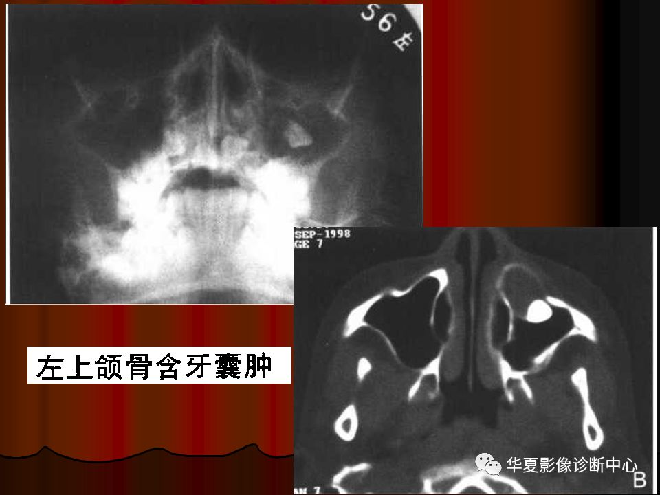 【PPT】口腔颌面部CT诊断