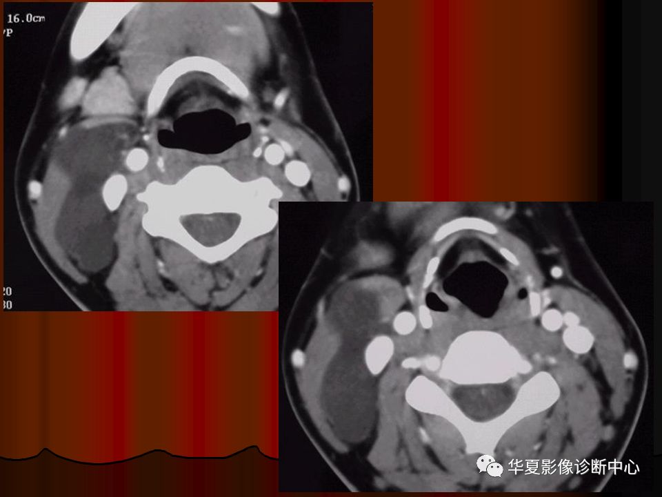 【PPT】口腔颌面部CT诊断