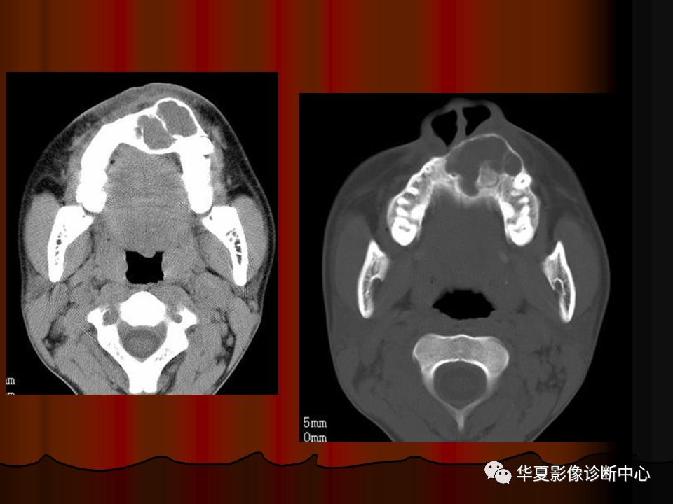 【PPT】口腔颌面部CT诊断