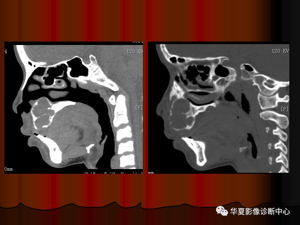【PPT】口腔颌面部CT诊断