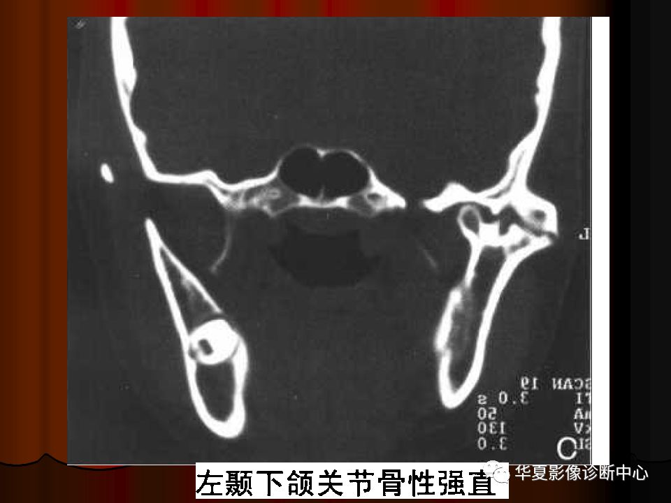 【PPT】口腔颌面部CT诊断