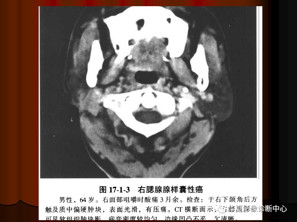 【PPT】口腔颌面部CT诊断