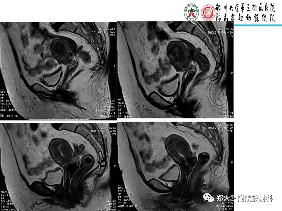 【PPT】如何判断盆腔肿瘤恶性淋巴结的转移