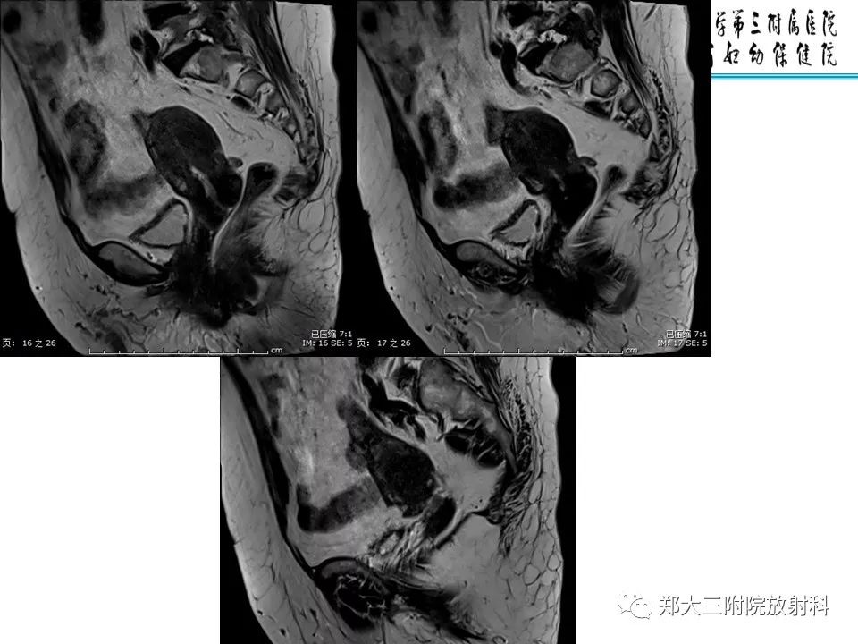 【PPT】如何判断盆腔肿瘤恶性淋巴结的转移