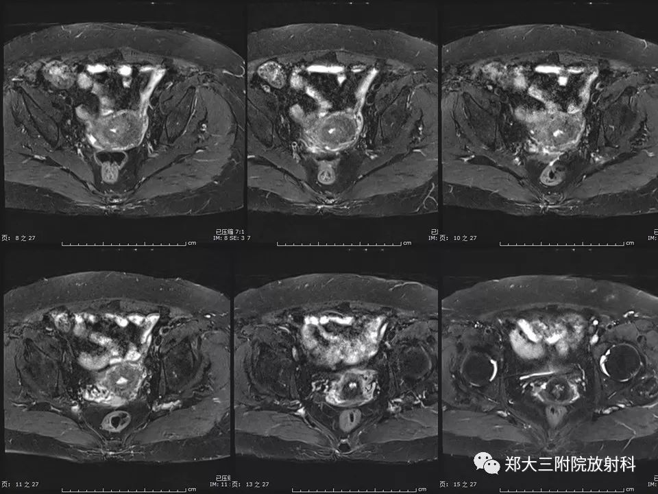 【PPT】如何判断盆腔肿瘤恶性淋巴结的转移