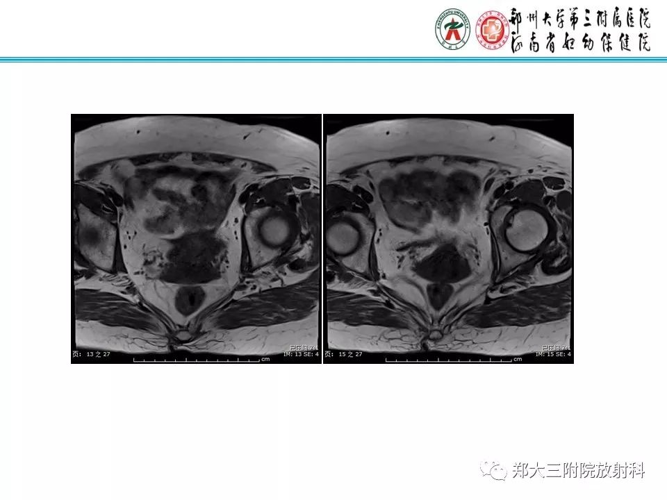 【PPT】如何判断盆腔肿瘤恶性淋巴结的转移