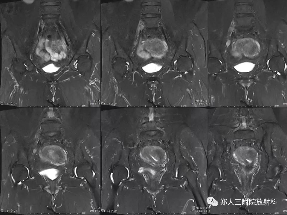 【PPT】如何判断盆腔肿瘤恶性淋巴结的转移
