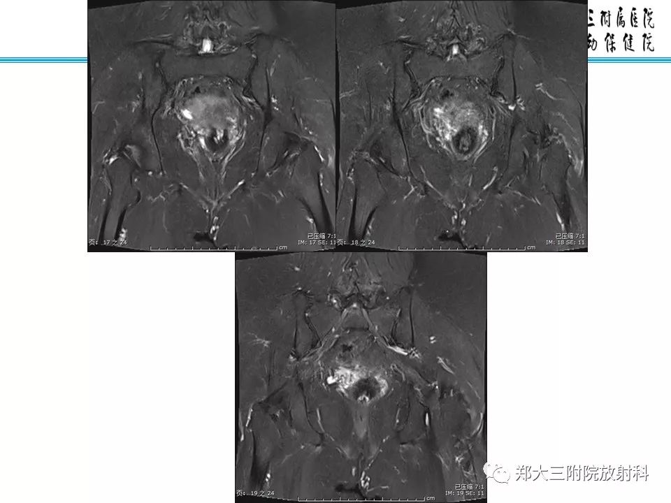【PPT】如何判断盆腔肿瘤恶性淋巴结的转移