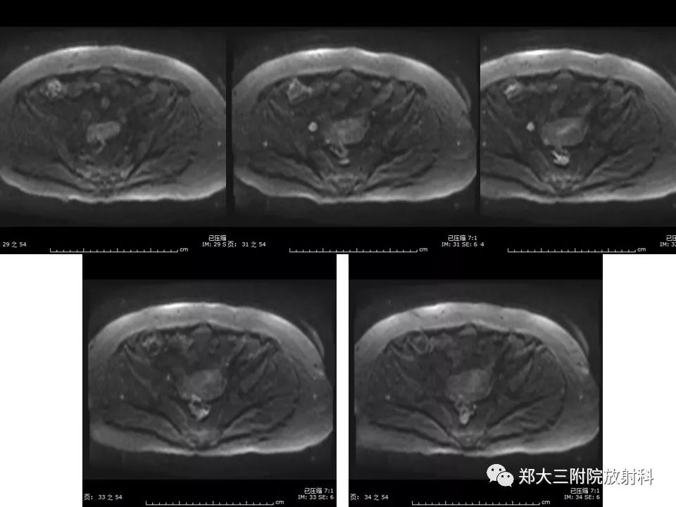 【PPT】如何判断盆腔肿瘤恶性淋巴结的转移
