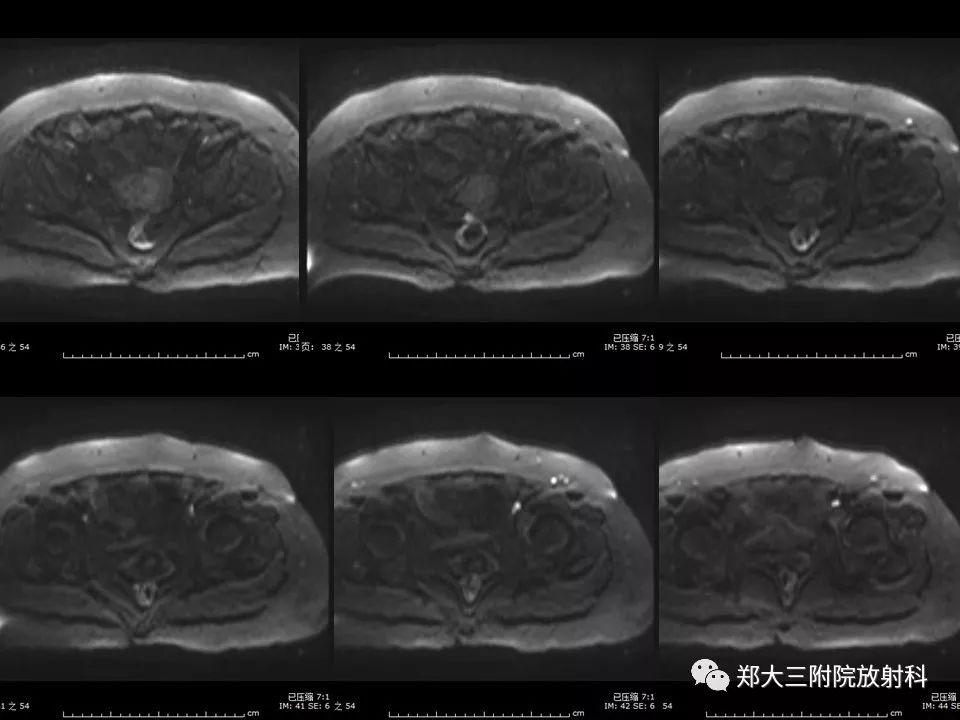 【PPT】如何判断盆腔肿瘤恶性淋巴结的转移