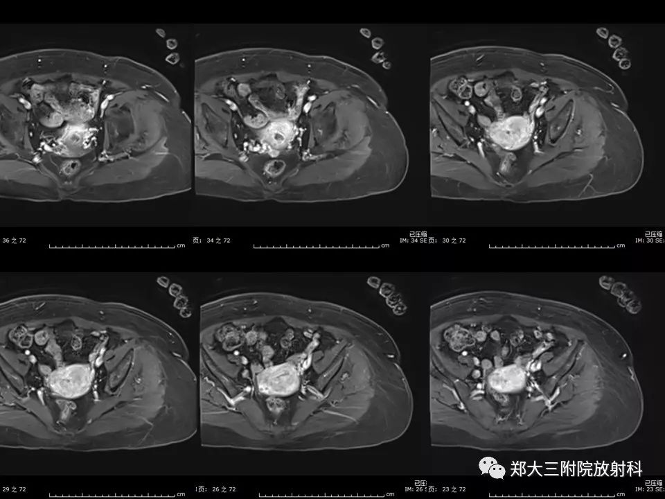 【PPT】如何判断盆腔肿瘤恶性淋巴结的转移