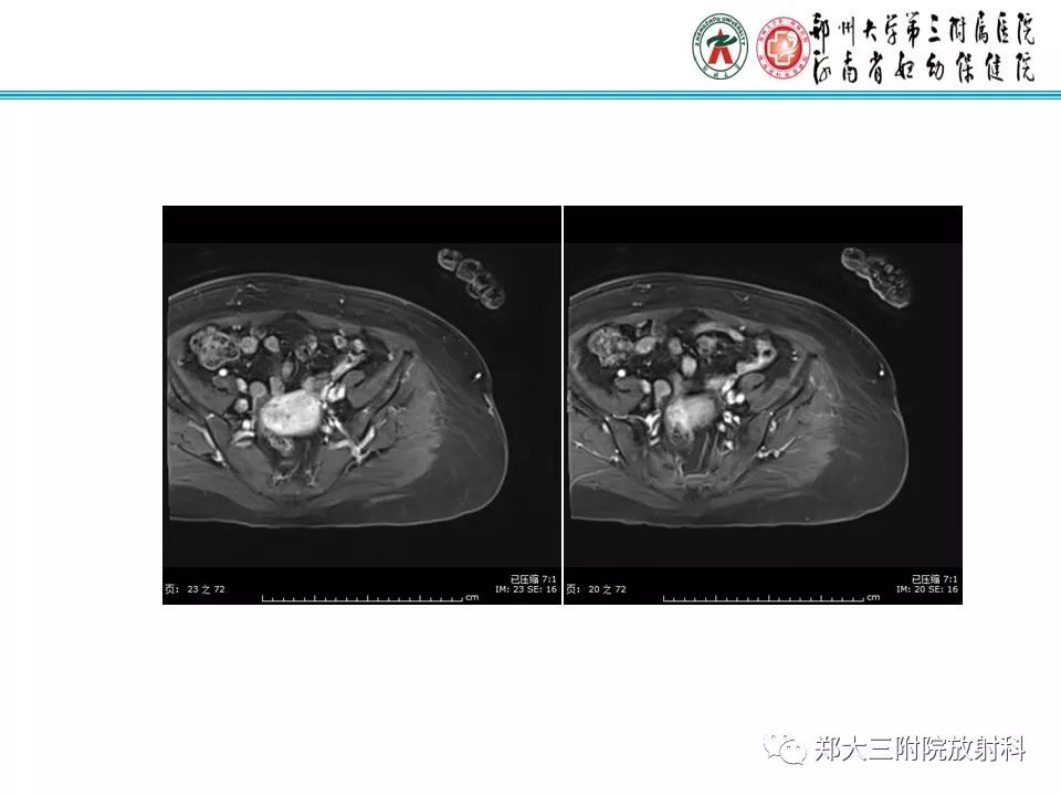 【PPT】如何判断盆腔肿瘤恶性淋巴结的转移