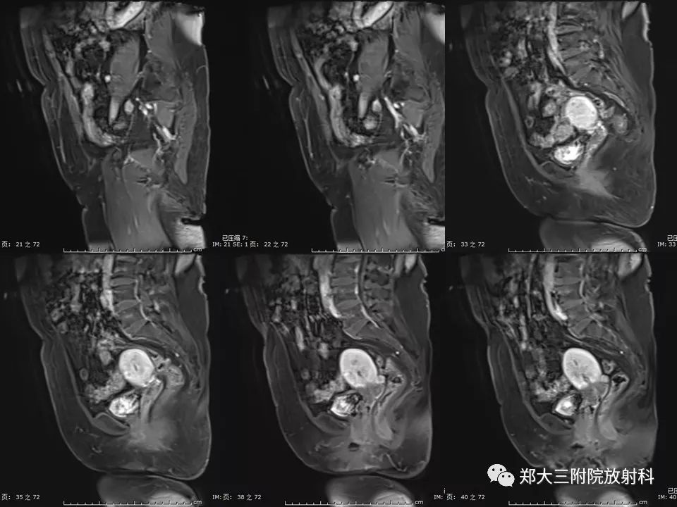 【PPT】如何判断盆腔肿瘤恶性淋巴结的转移