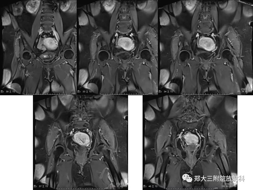 【PPT】如何判断盆腔肿瘤恶性淋巴结的转移