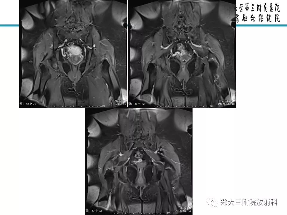 【PPT】如何判断盆腔肿瘤恶性淋巴结的转移