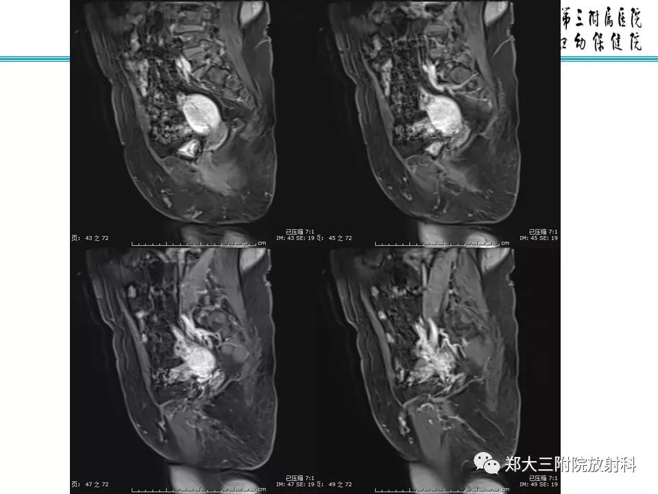 【PPT】如何判断盆腔肿瘤恶性淋巴结的转移