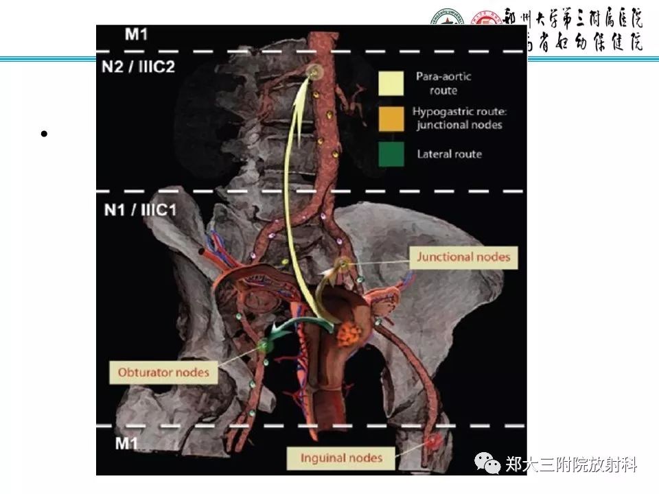【PPT】如何判断盆腔肿瘤恶性淋巴结的转移