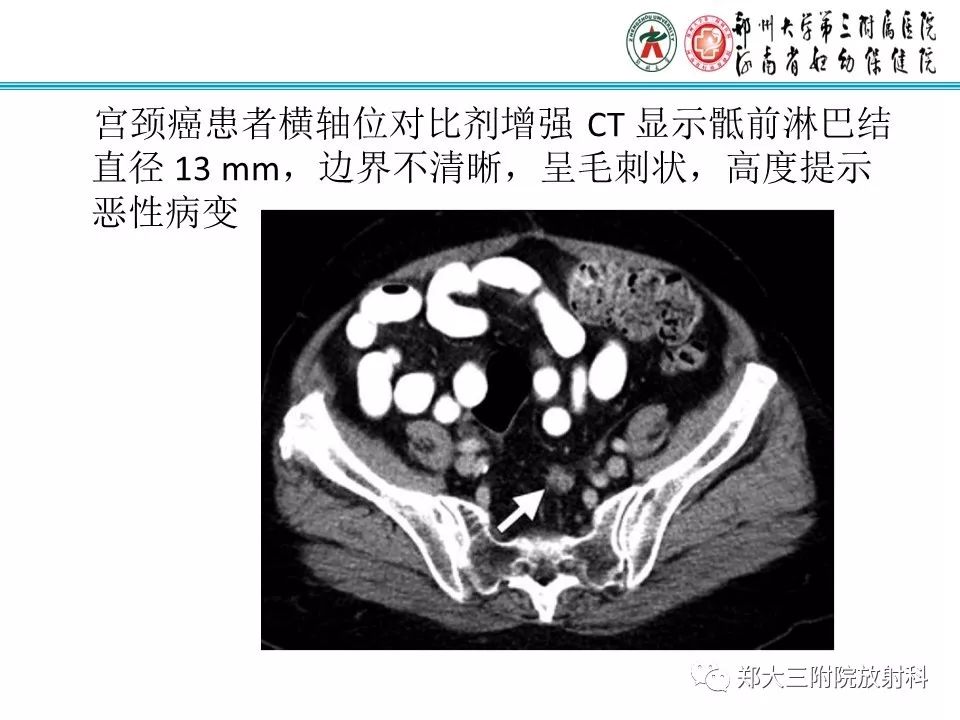 【PPT】如何判断盆腔肿瘤恶性淋巴结的转移
