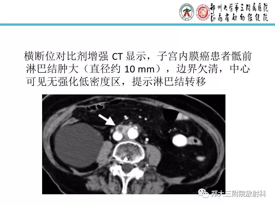 【PPT】如何判断盆腔肿瘤恶性淋巴结的转移